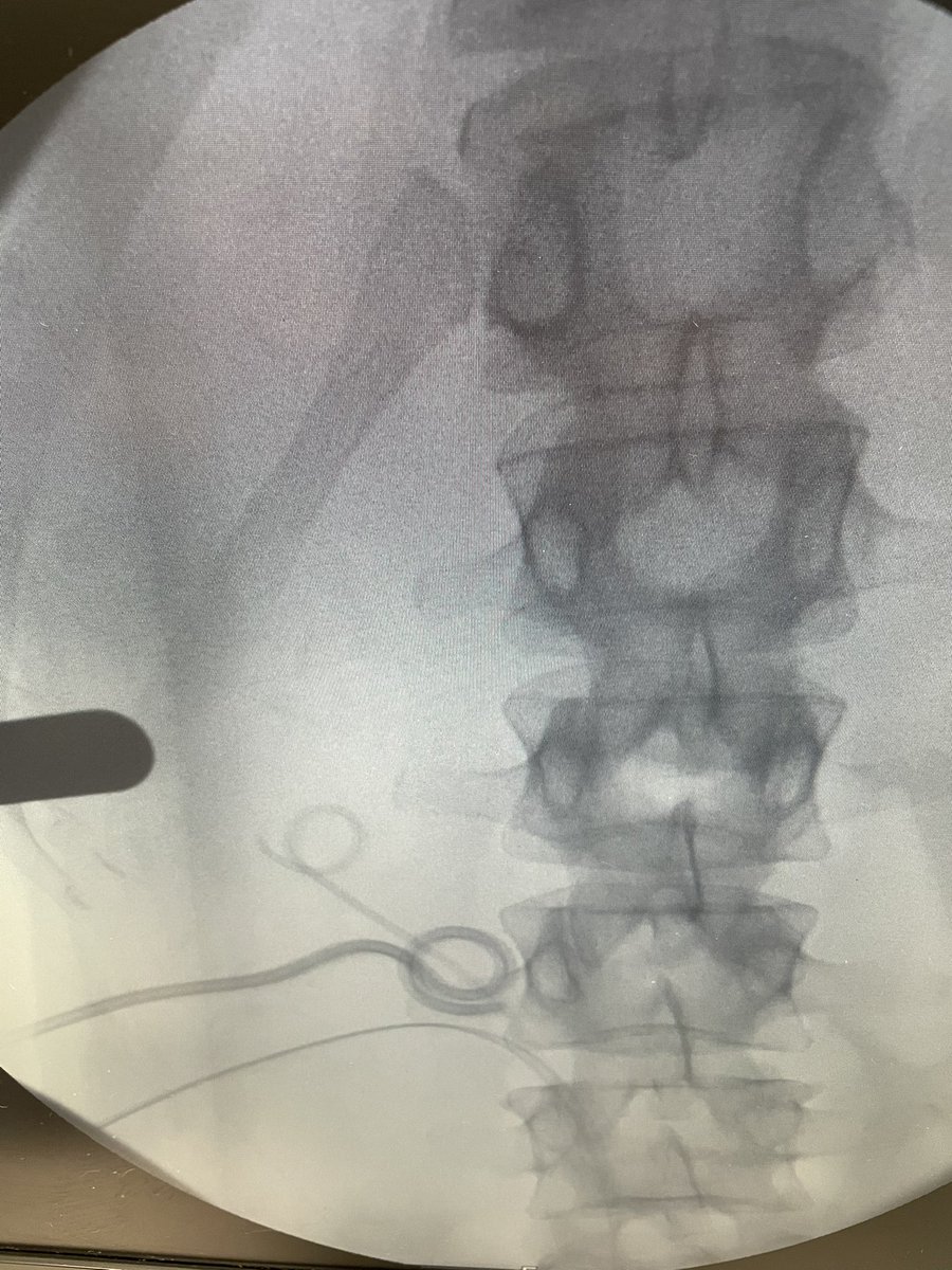 ECIRS miniperc multitract for the traetment of Bety complexión staghorn 2 sessions to complete <a href="/GasparIbarluzea/">gaspar ibarluzea</a> <a href="/JorgeMoraChris1/">Jorge Mora Christian</a> @cruhidisa 
ECIRS multitrayecto mini para el Tto de la litiasis coraliforme compleja, han sido necesarias 2 sesiones y todo el arsenal <a href="/UrologiaB/">Urologia Clinica Bilbao</a>