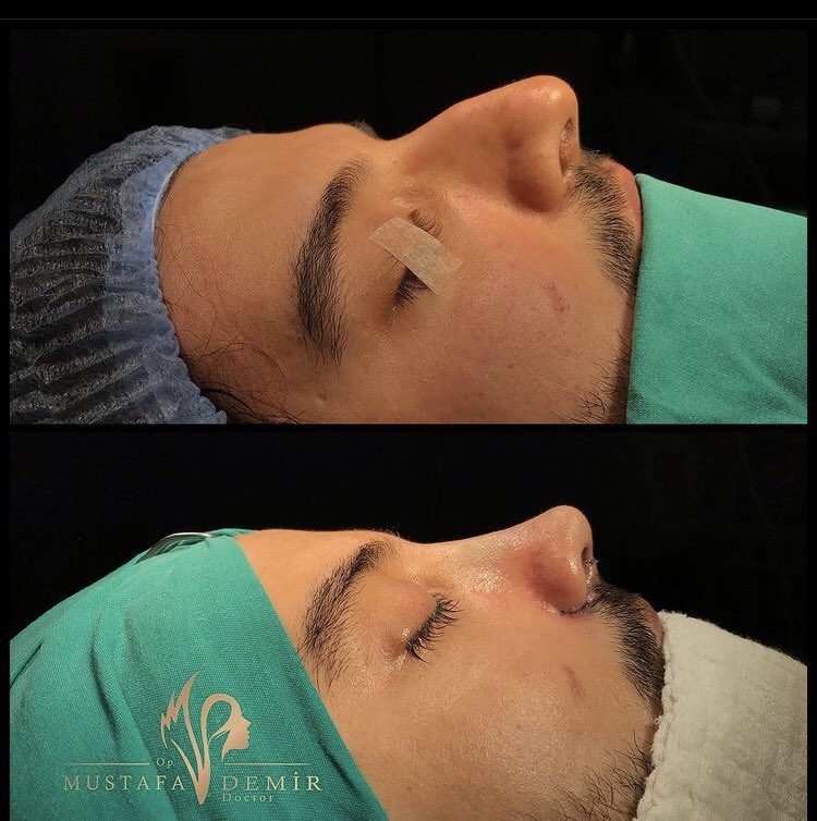 drmustafademir_'s tweet photo. Rhinoplasty with #piezosurgery. ✅Please contact us for information and appointment on DM or Whatsapp 👉👉. ☎️ +905325065036

#piezoburunestetiği ❇️Ücretsiz muayene ve bilgi için DM ‘den ya da Whatsapptan bize ulaşabilirsiniz 👉👉☎️ 05325065036 https://t.co/hB2i0WO5S3