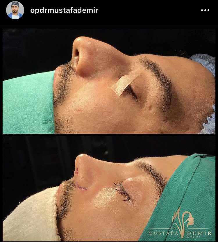 drmustafademir_'s tweet photo. Rhinoplasty with #piezosurgery. ✅Please contact us for information and appointment on DM or Whatsapp 👉👉. ☎️ +905325065036

#piezoburunestetiği ❇️Ücretsiz muayene ve bilgi için DM ‘den ya da Whatsapptan bize ulaşabilirsiniz 👉👉☎️ 05325065036 https://t.co/hB2i0WO5S3