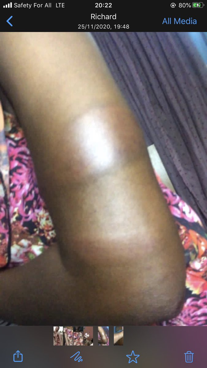 Lucy_Anaaa's tweet photo. My friend Olaide was brutally assaulted by the men of the Nigerian Army today in Songotedo because she refuse to greet them. 

Kindly help me retweet to get to the appropriate authorities. https://t.co/hkG5KcY4od