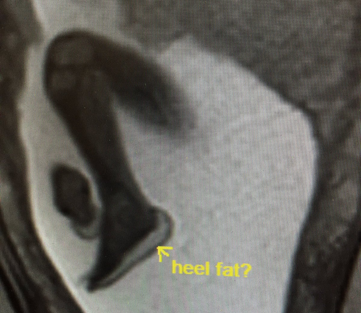 On the next (and so far, only) segment of #WhyIChose #PediatricRadiology: Day 3 on Fetal Imaging and I’ve discovered heel fat 🦶🏻 #fetal #radiology #imaging #MedEd #nothydrops #preThanksgivingvibes #HumpDayVibes #education #fetalMRI #MRI #FetalImaging #prenatal #OB #obstetrics