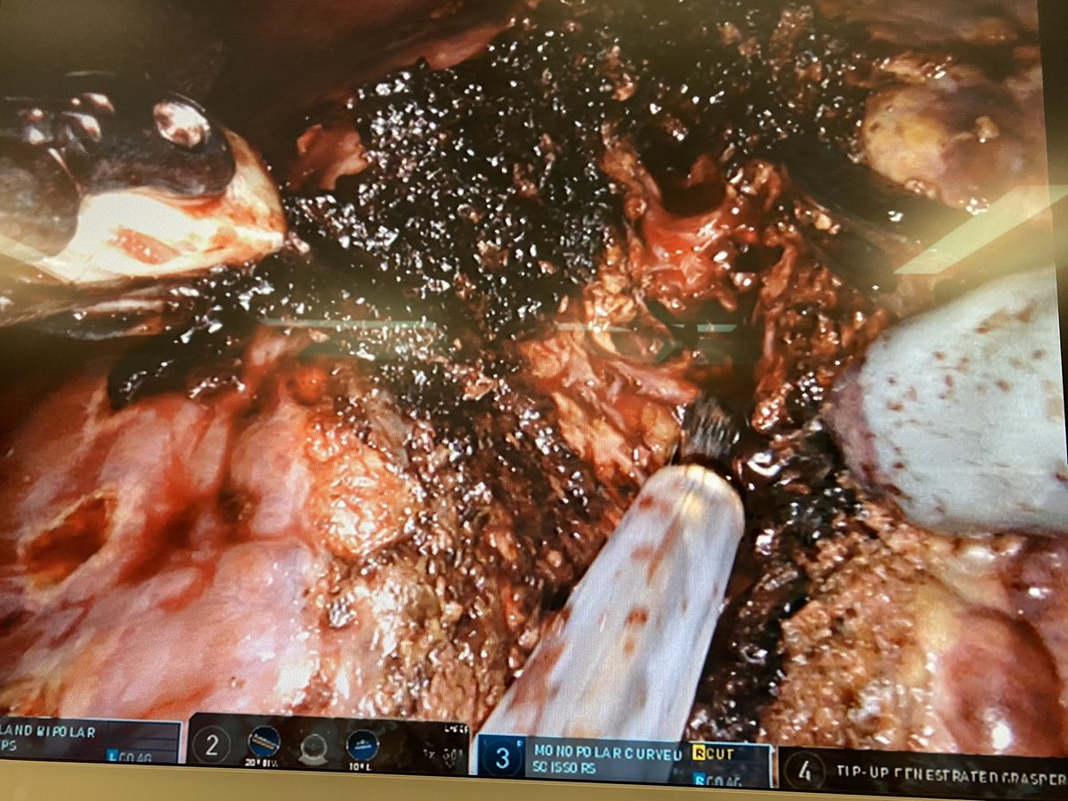 Cirugía HBP y Gástrica H. Arnau de Vilanova Lérida (@hbp_eglleida) on Twitter photo Doble sesión de Cirugía Hepática Robótica por HCC, asistidos con CUSA
Caso1: Sectorectomia lateral derecha
Caso2: Resección atípica sV/VIII
Team: <a href="/AlfredoEscartin/">Alfredo Escartin</a> <a href="/JimyJara/">Jimy Jara</a> <a href="/HelenaSalvadorR/">Helena Salvador</a> <a href="/pmuriel_al/">Pablo Muriel</a> <a href="/ffrank_vp/">Frank Vela</a> <a href="/martagodu/">Marta GoDu</a> <a href="/JjOlsina/">JJOlsina</a>
@seccionhbpaec <a href="/HpbMar/">HPB unit Hospital del Mar</a> <a href="/IHPBA/">IHPBA</a> <a href="/abexDaVinci/">ABEX Excelencia Robótica</a> Doble sesión de Cirugía Hepática Robótica por HCC, asistidos con CUSA
Caso1: Sectorectomia lateral derecha
Caso2: Resección atípica sV/VIII
Team: <a href="/AlfredoEscartin/">Alfredo Escartin</a> <a href="/JimyJara/">Jimy Jara</a> <a href="/HelenaSalvadorR/">Helena Salvador</a> <a href="/pmuriel_al/">Pablo Muriel</a> <a href="/ffrank_vp/">Frank Vela</a> <a href="/martagodu/">Marta GoDu</a> <a href="/JjOlsina/">JJOlsina</a>
@seccionhbpaec <a href="/HpbMar/">HPB unit Hospital del Mar</a> <a href="/IHPBA/">IHPBA</a> <a href="/abexDaVinci/">ABEX Excelencia Robótica</a>