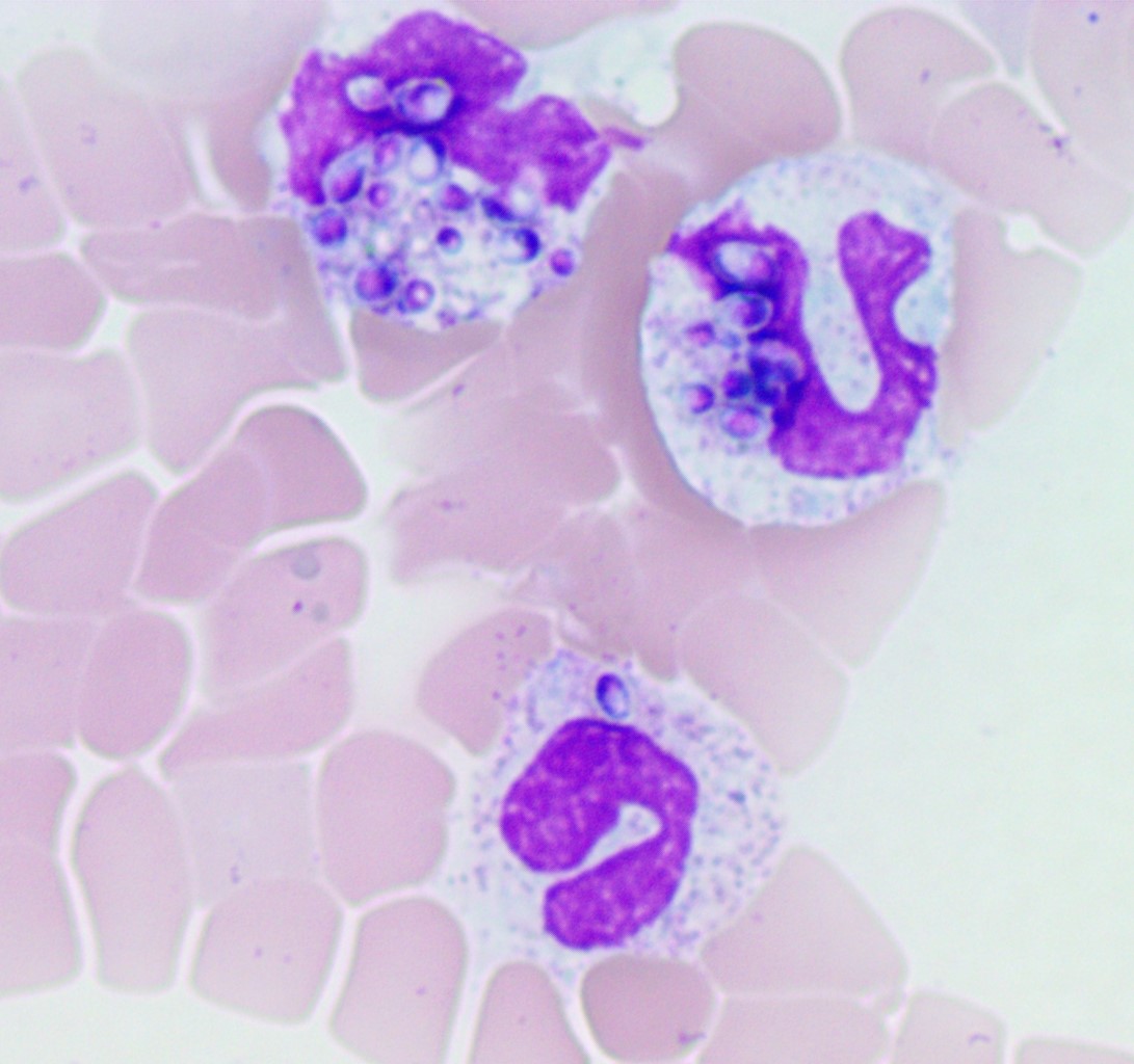 alnoorakber's tweet photo. #Hemepath #Micromed #PathTwitter
27 years old male with a known history of HIV, presented with anemia and leukocytosis with left shift. Any guesses on this peripheral smear?
@BroojAbro @SkybhatiaMD @dratifraja @debpratik @QandeelSadiq @faixanmalik @EShuyu @MahreenMD https://t.co/H6ExztQ5EY