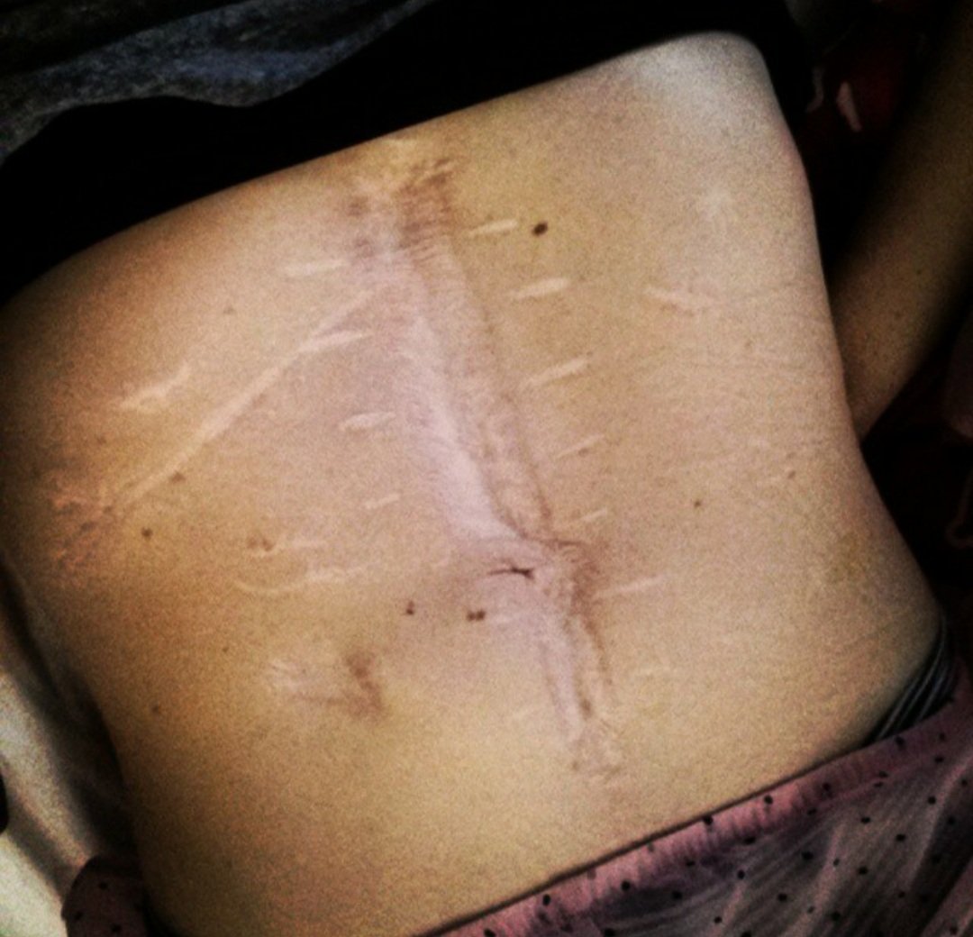 dianabetes's tweet photo. I once was ashamed that I had "lost" my belly button. Now I am proud of my scars - they tell a visual story about my new (albeit difficult) life. 💯👍❤ #scarpride https://t.co/qPQYmTv3Fh