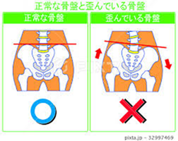 骨盤の歪み ひずみのtwitterイラスト検索結果