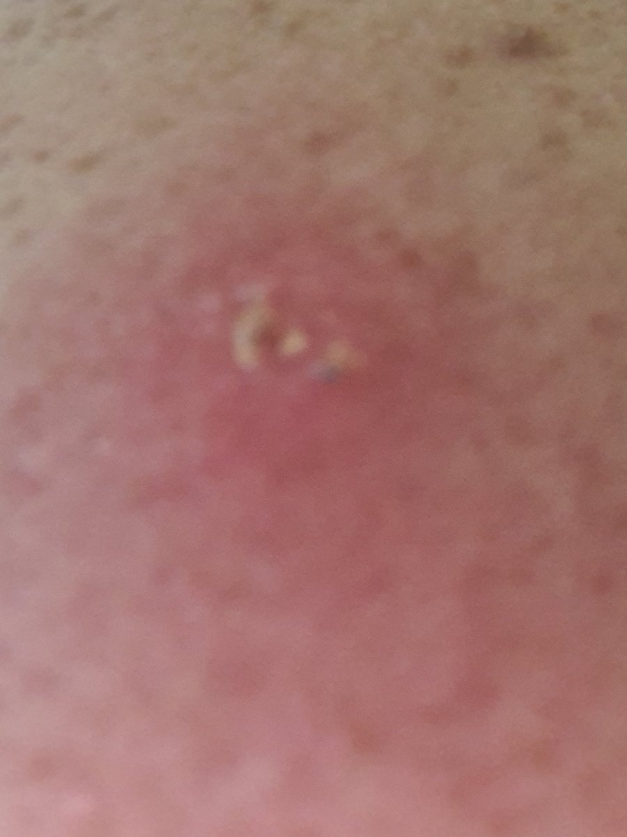 nikkimaloo's tweet photo. Hello Twitter, is this a spider bite? And if so, any idea on what kind? https://t.co/GmHT8fBVAw