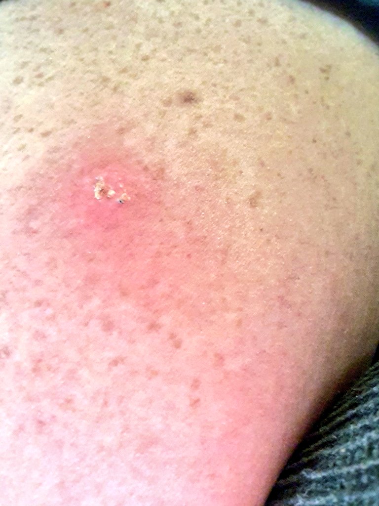 nikkimaloo's tweet photo. Hello Twitter, is this a spider bite? And if so, any idea on what kind? https://t.co/GmHT8fBVAw
