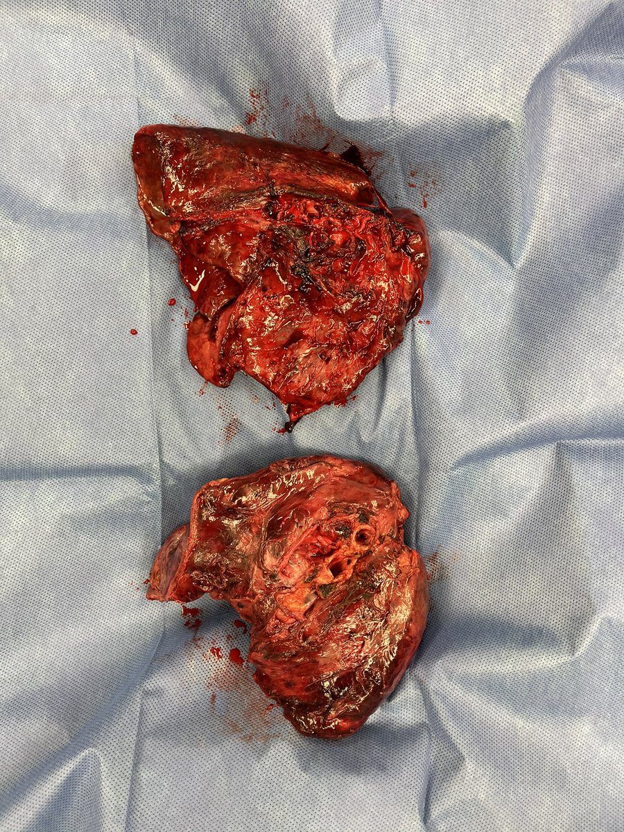 Ankit Bharat, MD FACS tweet media