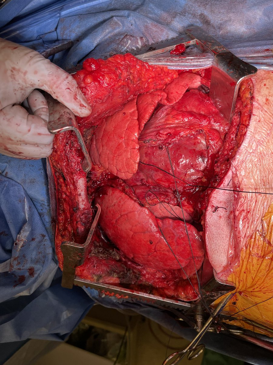 Ankit Bharat, MD FACS tweet media