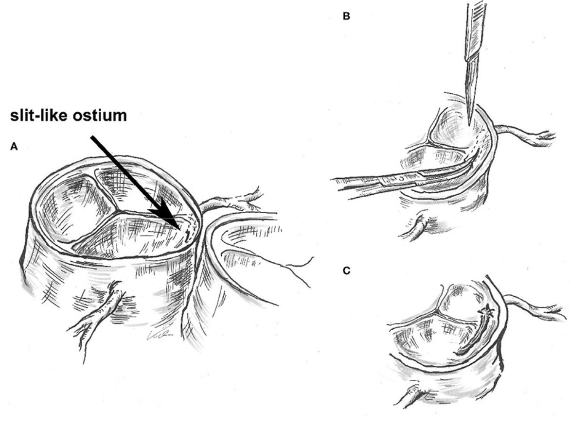 chrisgraeni's tweet photo. Great drawing of „#unroofing“ the intramural segment of an anomalous coronary artery #ACAOS #AAOCA by our heart surgeon Prof. Alexander Kadner. Read our case series of ‚Symptomatic Coronary Anomalies and Ischemia in Teenagers – Rare but Real‘ https://t.co/Z3O7V2p46M #inselgruppe https://t.co/LFKdvDL0Za