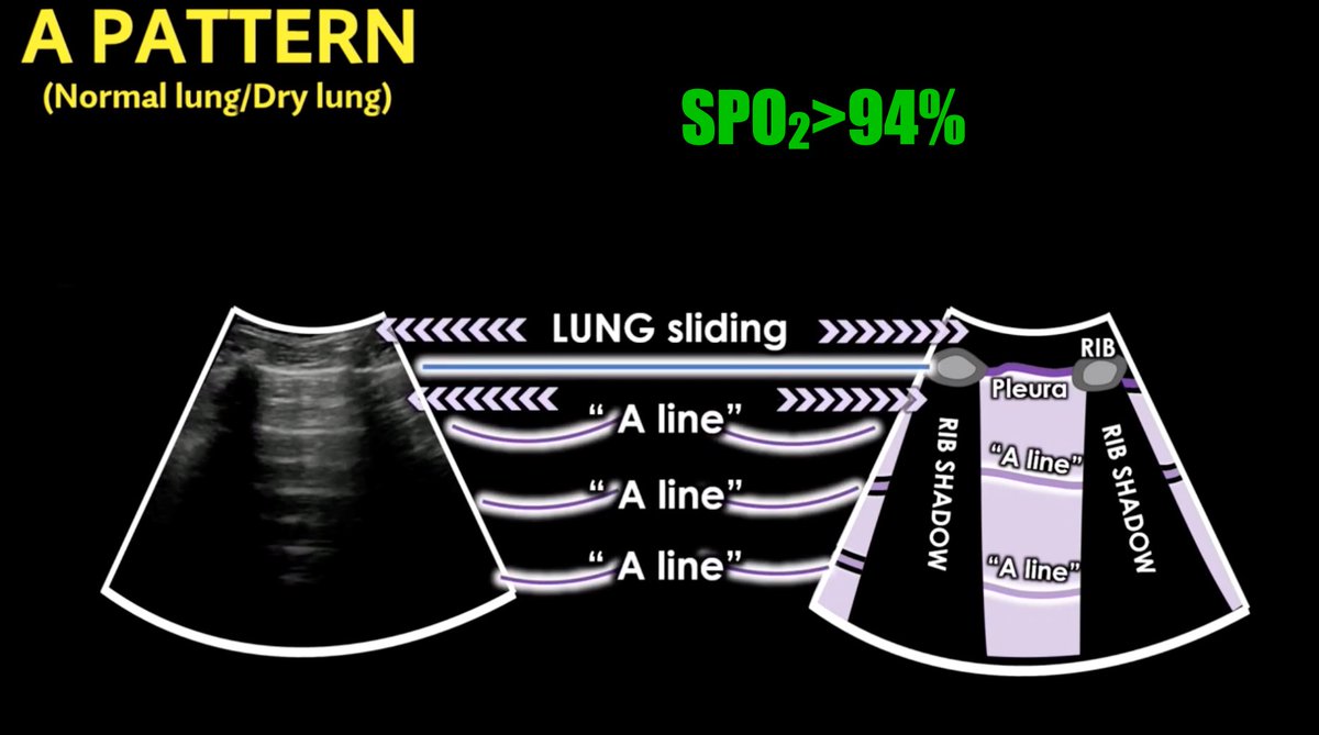 FOAMecmo's tweet photo. Lung #POCUS patterns &amp; #COVID19 
📌A normal
pleural line sliding (top), A lines artifactual repetitions
📌B mild to moderate-severe/wet lung
vertical lines ➡️ subpleural interstitial edema
⬆️ B lines ⬆️ severity
confluent/irregular-thick pleura: worrying
@Wilkinsonjonny #IFAD2020 https://t.co/mFRAAQnToY