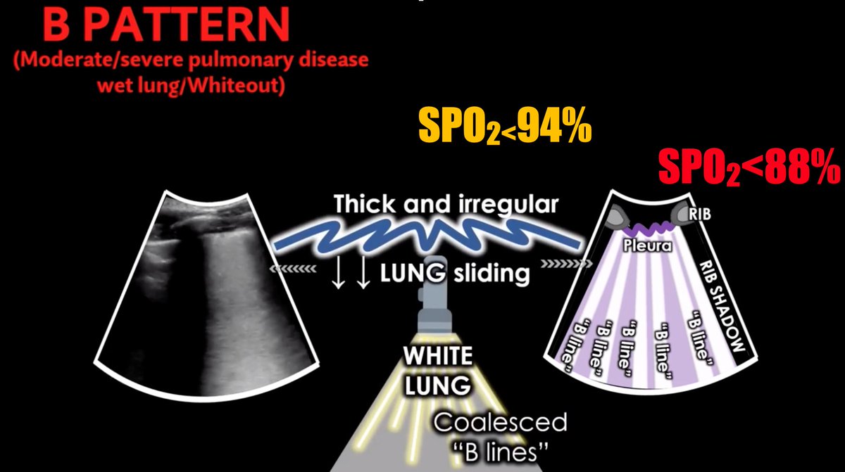 FOAMecmo's tweet photo. Lung #POCUS patterns &amp; #COVID19 
📌A normal
pleural line sliding (top), A lines artifactual repetitions
📌B mild to moderate-severe/wet lung
vertical lines ➡️ subpleural interstitial edema
⬆️ B lines ⬆️ severity
confluent/irregular-thick pleura: worrying
@Wilkinsonjonny #IFAD2020 https://t.co/mFRAAQnToY