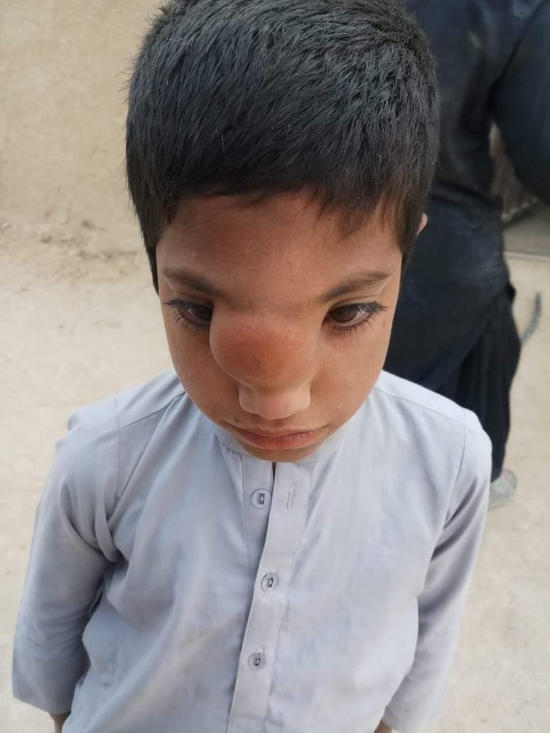 mirmari4's tweet photo. تحصیل زہری سے تعلق رکھنے والا بچہ بلال آحمد جن کے چہرے پر بچپن سے ایک دانہ ہے لیکن اب عمر کے ساتھ دانہ بڑھ رہا ہے ڈاکٹرز کا کہنا ہے اگر بر وقت اس کو آپریشن نہیں کیاگیا تو انکے دونوں آنکھیں متاثر ہوسکتے  ھیں.یہ علاج کرنے کے سکت نہیں رکھتے
شیئر کرنا نہ بھولیں شکریہ 🙏
03337937538 https://t.co/DFWts8Q707