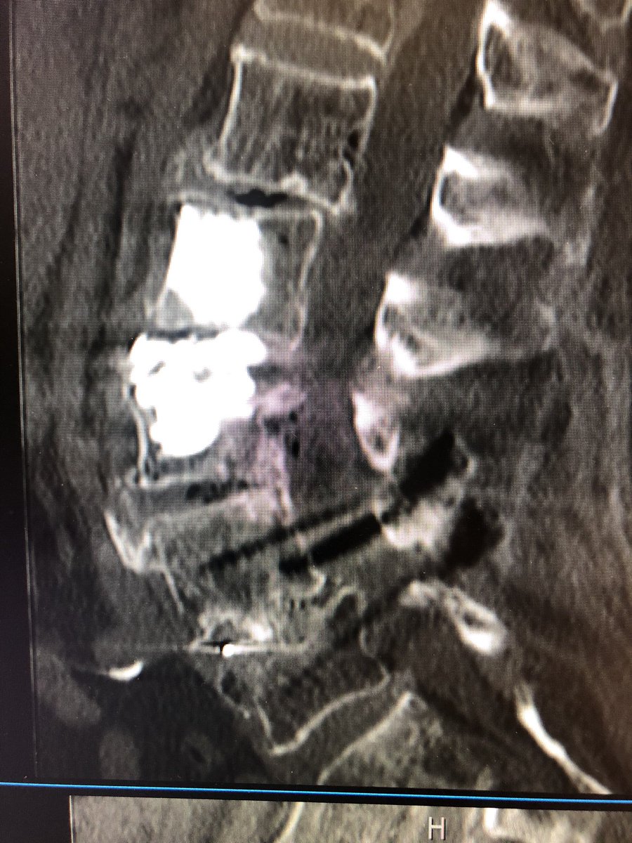 Before and after treatment of #VCFs adjacent to a fusion. #spinalstenosis prominently improved. #SpineJack @TheStrykerIVS @SIRspecialists @ASIPP @NottsOsteoporo1 @RoyalOsteoSoc @OsteoporosisNOF @The_ASSR @TheASNR @_backtable @rdeleacymd @neuroradiology @ImagingDoctor @WayneOlan