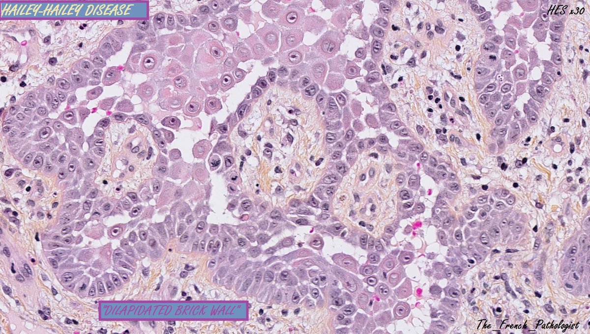 The_French_Path's tweet photo. Hailey-Hailey disease 🤓📚🔬with classic "dilapidated brick wall" appearance
#pathology #pathologist #medecine #Pathresident #internat #microscopy #The_French_Pathologist #francophonepath #pathtwitter #medtwitter #dermatopath #pathboards #dermatology @PathSpotters #anapath https://t.co/wI6bbrHdKp