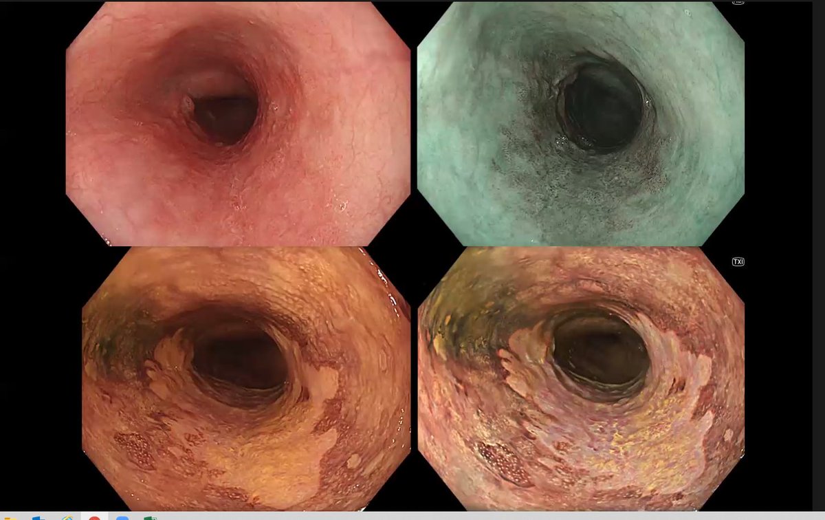SEED (@seedendoscopia) on Twitter photo Simposio <a href="/OlympusMedEMEA/">Olympus Medical Systems EMEA</a> en #SEED2020: El Dr Stefan Seewald explica la nueva plataforma EVIS X1, comparando imágenes del antiguo y el nuevo procesador. La nueva lente dual permite un 30% más de magnificación
Próximamente la sesión completa en virtual.seed2020.es
#Olympus Simposio <a href="/OlympusMedEMEA/">Olympus Medical Systems EMEA</a> en #SEED2020: El Dr Stefan Seewald explica la nueva plataforma EVIS X1, comparando imágenes del antiguo y el nuevo procesador. La nueva lente dual permite un 30% más de magnificación
Próximamente la sesión completa en virtual.seed2020.es
#Olympus