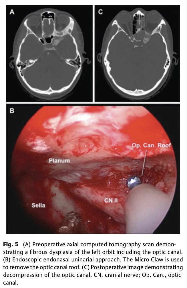 NASBSorg's tweet photo. #JNLSB_Classic
Application of Ultrasonic Bone Curette in Endoscopic Endonasal Skull Base Surgery: Technical Note
#nsgy #ent #EEA #technique #insturments #BoneScalpel #skullbase #ultrasound #NASBS @PittNeurosurg @Pitt_ENT
https://t.co/tqJnix7q9Q https://t.co/e1wJaWj62d