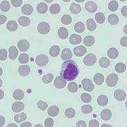 horibamedical's tweet photo. QSP 7#quiztime: the answer! The #film indicates a normal film, #redbloodcells are #normochromic and #normocytic, #WBC #morphology normal, with a normal distribution of #platelets. The film is from a female, 43 years old with the following parameters: (see in the comment) https://t.co/q9SOOe4sHL