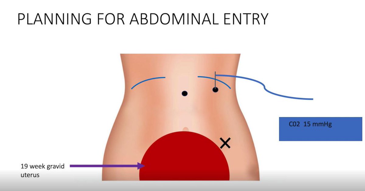 The Green Journal (@greenjrnl) on Twitter photo New Video Available: Laparoscopy in the pregnant patient: an educational video #obgyn #OB ow.ly/xnFr50CHW5G <a href="/SamBenloloMD/">Samantha Benlolo</a> New Video Available: Laparoscopy in the pregnant patient: an educational video #obgyn #OB ow.ly/xnFr50CHW5G <a href="/SamBenloloMD/">Samantha Benlolo</a>