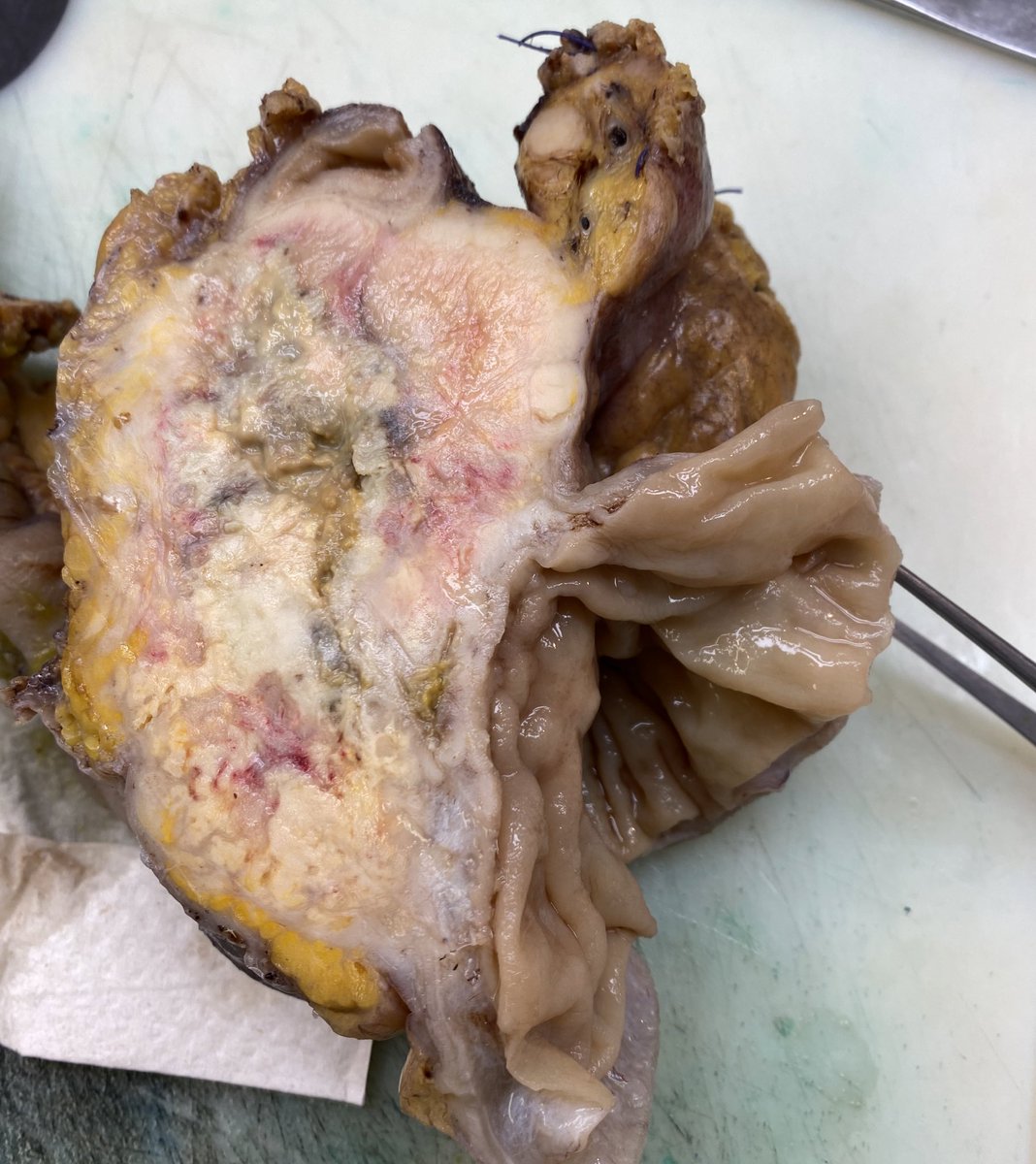 An Capoen (@ancapoen) on Twitter photo Ga alstublieft naar je dokter bij klachten.
Deze tumor heeft een diameter van 10 cm en is dus al even aan het groeien.
Dit is geen uitzondering deze week.
<a href="/StopDarmkanker/">Stop Darmkanker</a> <a href="/LucColemont/">Dr. Luc Colemont</a> #darmkanker
Indien klachtenvrij en tussen 50-75j: DOE. DE. TEST. 💩 Ga alstublieft naar je dokter bij klachten.
Deze tumor heeft een diameter van 10 cm en is dus al even aan het groeien.
Dit is geen uitzondering deze week.
<a href="/StopDarmkanker/">Stop Darmkanker</a> <a href="/LucColemont/">Dr. Luc Colemont</a> #darmkanker
Indien klachtenvrij en tussen 50-75j: DOE. DE. TEST. 💩