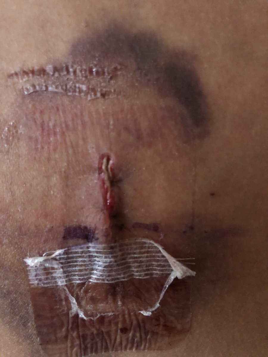 dannygrotbags's tweet photo. Not going to lie I probably was the worst patient @RGNSamD has had to change a dressing on in a while from cry to going dizzy coz I pulled the strips off as well as the dressing 🥴 🤮#backop https://t.co/kdOcCt3Pjf