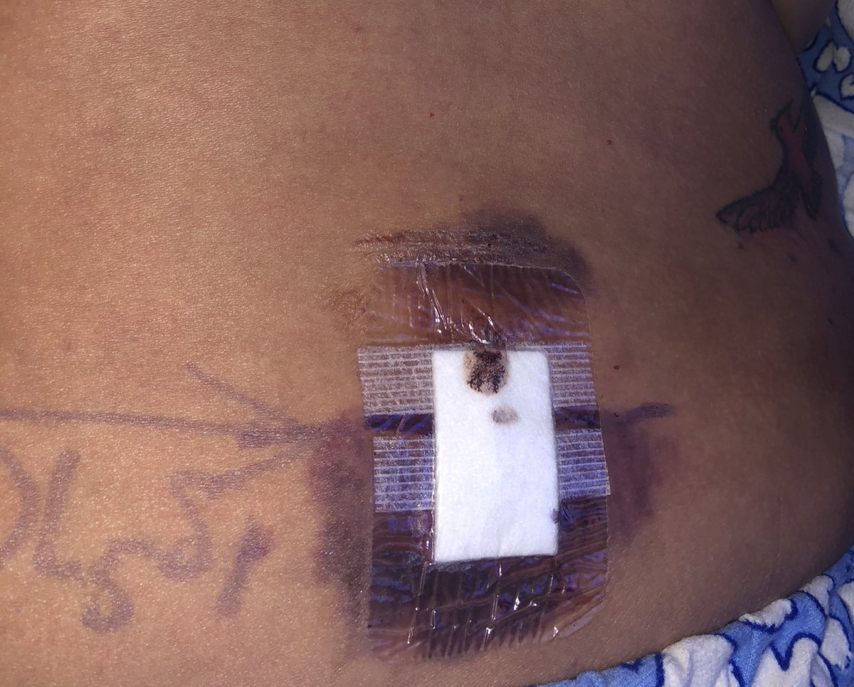 dannygrotbags's tweet photo. Not going to lie I probably was the worst patient @RGNSamD has had to change a dressing on in a while from cry to going dizzy coz I pulled the strips off as well as the dressing 🥴 🤮#backop https://t.co/kdOcCt3Pjf