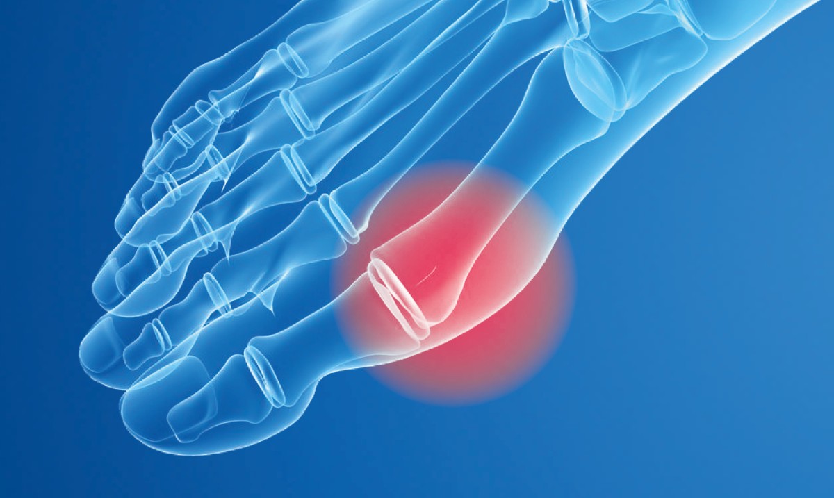 Do you suffer with #Bunions? A bunion is a bony deformity of the joint at the base of the big toe. Our inner longitudinal arch support reaches under the 1st metatarsal, raising it to distribute bodyweight evenly.

#FootCare #FootHealth
