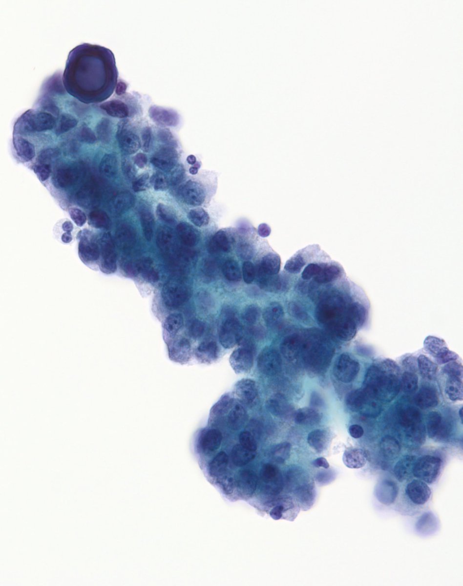sza_jhcyto's tweet photo. Nothing is 100% specific in morphology but “Psammoma Bodies” get pretty close to that number for “Papillary Thyroid Carcinoma”. I have seen them rarely in Hashimoto thyroiditis and others have described them in lesions, such as, benign papillary hyperplasia, Graves’, etc. https://t.co/VkYNqP4LzS