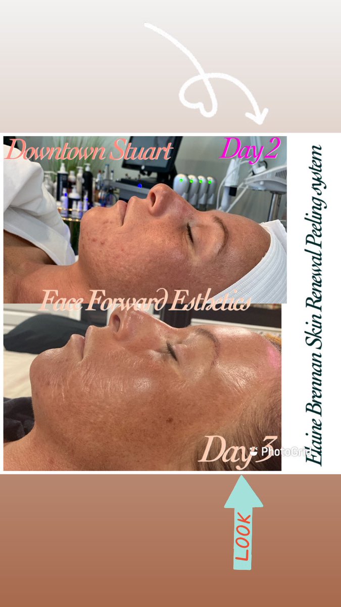 FaceForward10's tweet photo. Ok, this is a look 👀into the life of The Elaine Brennan Skin Renewal Peeling system! Now on day 3! Pigmentation will continue to lift and its working deeper into the layers as cellular activity is taking steps to produce new skin! https://t.co/s9QTnZKqYy