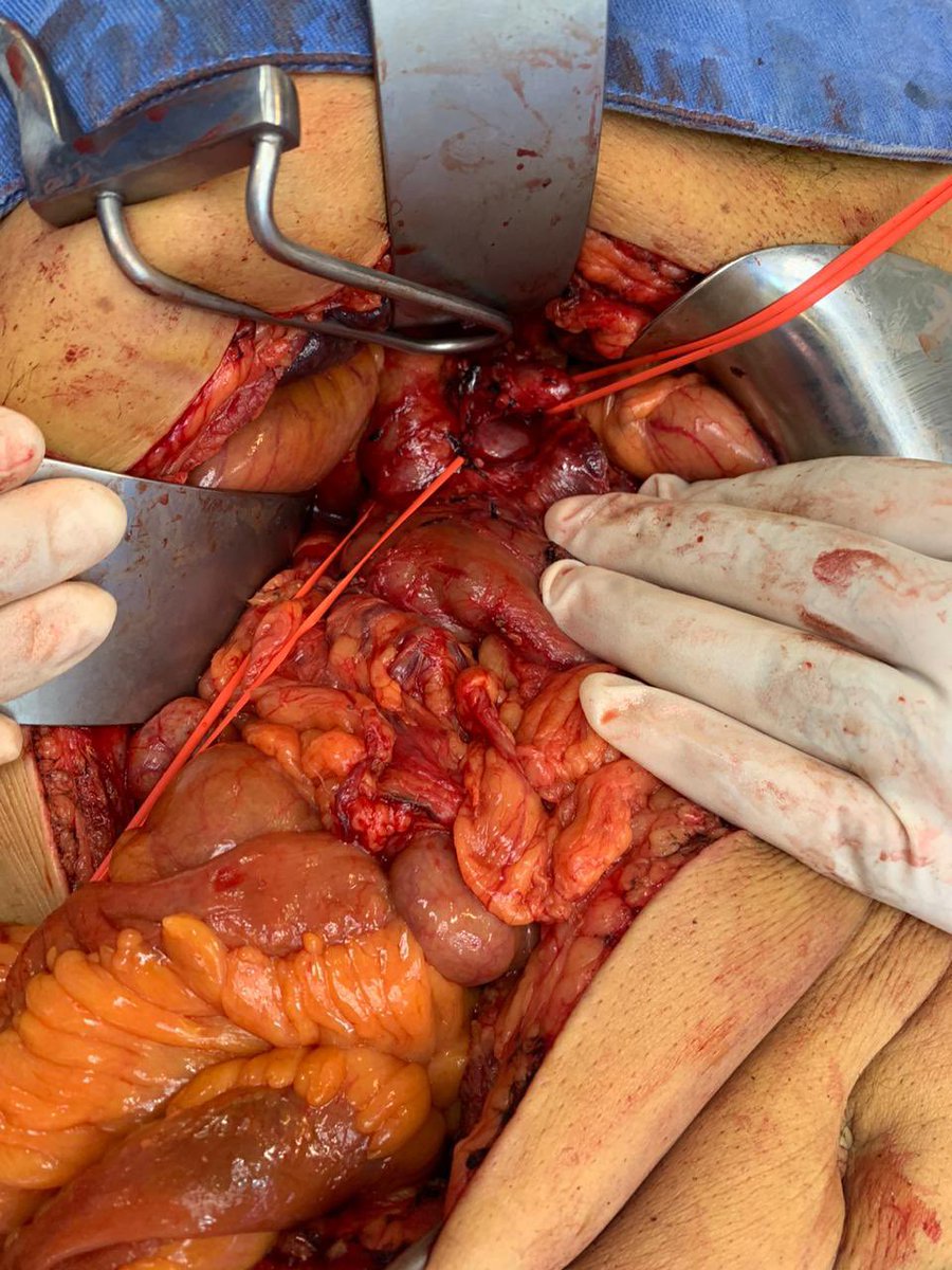Desafortunadamente la cuenta <a href="/anhanssen/">Andrés Hanssen</a> ha sido bloqueada por #tweeter por  unas imágenes de estructuras anatómicas tomadas del campo quirúrgico durante una pancreato-duodenectomía. Incomprensible en mi criterio. Desde hace cuatro días en espera del resultado de apelación.