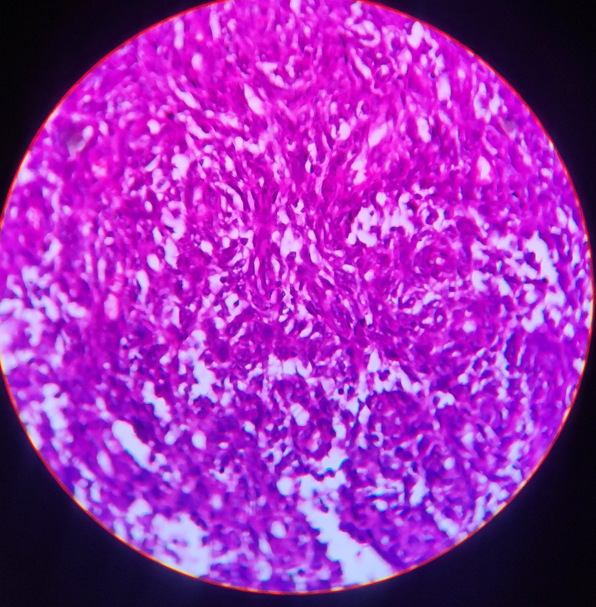 BhuvaneshwariA8's tweet photo. 40 year female, 
Nasal mass extending into cranial cavity with erosion of cribriform plate
MRI- ? Esthinonuroblastoma
What could be the diagnosis? https://t.co/ReF5zqphuj