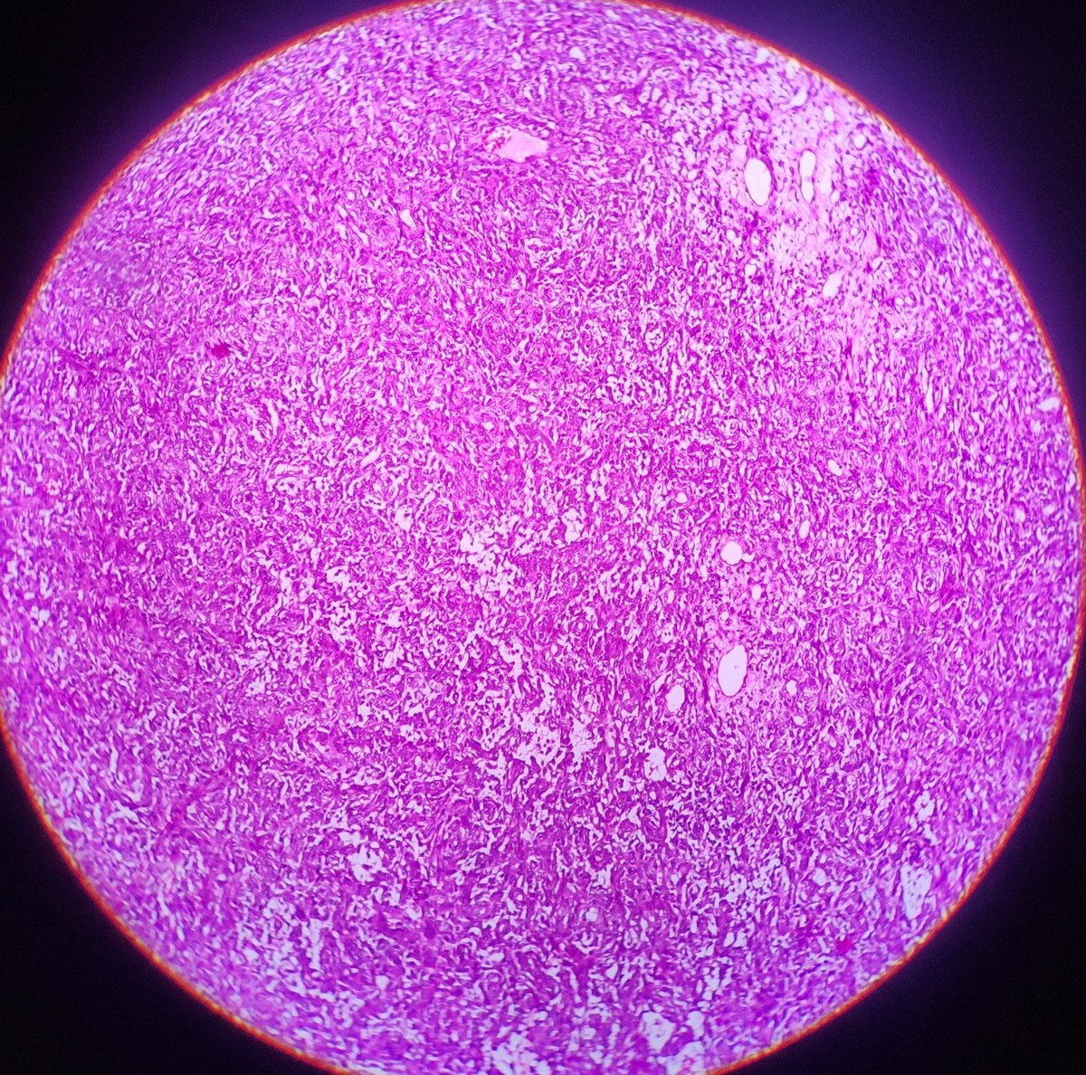 BhuvaneshwariA8's tweet photo. 40 year female, 
Nasal mass extending into cranial cavity with erosion of cribriform plate
MRI- ? Esthinonuroblastoma
What could be the diagnosis? https://t.co/ReF5zqphuj