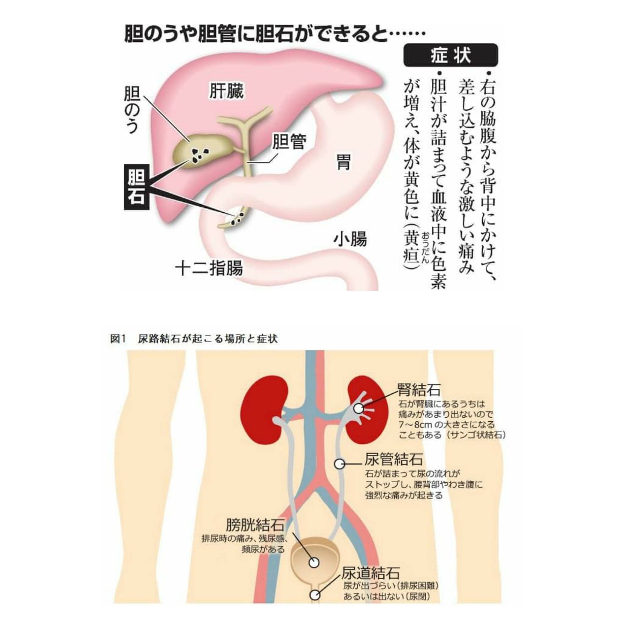 Hideki 11 三十代で胆石と胆嚢ポリープで胆嚢を切除し これで二度とお腹に石は出来ないだろうと思ってたら三週間前に背中に痛みが ロ 癌にでもなったかと思っていたが 3日ほどして背中の痛みは無くなったが 代わりに膀胱に違和感が ホロホロ 腎