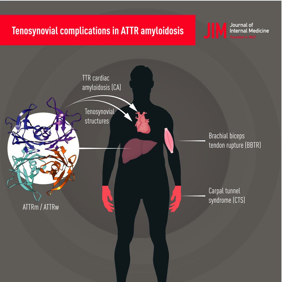Presence of bilateral carpal tunnel syndrome and/or biceps tendon rupture is highly predictive of ATTR-CA in both general population and hypertrophic phenotype subgroup @Cappellifrance2  @IacopoOlivotto  @Cardioinfo_it  https://doi.org/10.1111/joim.13200
