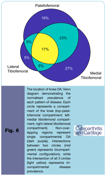 DrAmyGarner's tweet photo. Huge paper from Jen Stoddart showing just 17% of patients have tricompartmental arthritis, the rest may be suitable for partial or combined partial arthroplasty, retaining healthy bone and functional cruciate ligaments #knee #arthritis #CompartmentalApproach #appropriateSurgery https://t.co/IACGYm2PmO