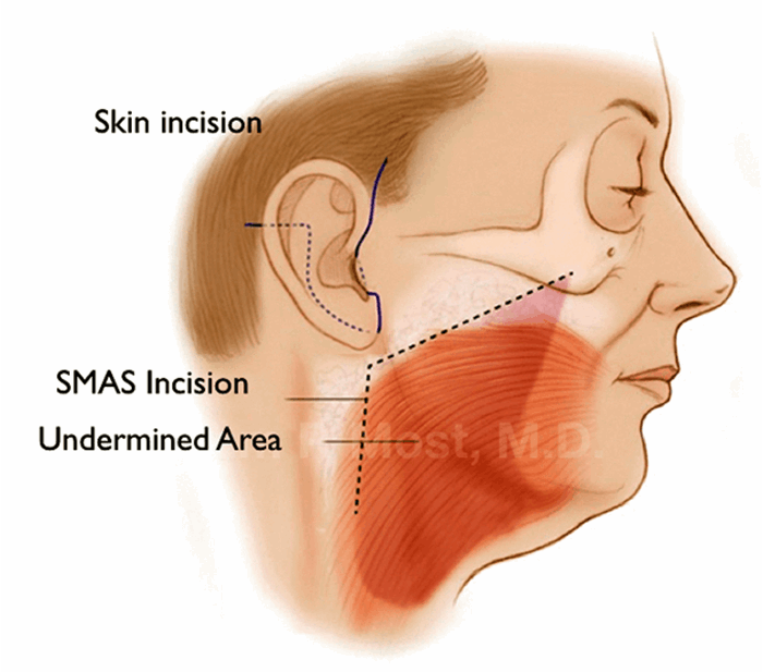 The PMFA Journal (@pmfajournal) on Twitter photo As there are so many options besides #surgery available to patients, this has led to misconceptions and myths about facelifts - Read more from Akshay Sanan and <a href="/smostmd/">Sam Most, MD</a> on the truth behind #facelift myths
Read the article here > bit.ly/3n8PS7t As there are so many options besides #surgery available to patients, this has led to misconceptions and myths about facelifts - Read more from Akshay Sanan and <a href="/smostmd/">Sam Most, MD</a> on the truth behind #facelift myths
Read the article here > bit.ly/3n8PS7t