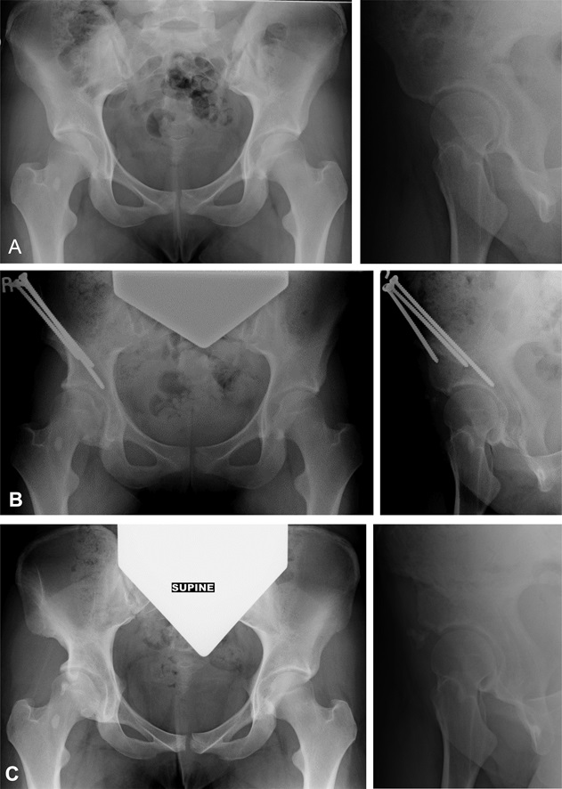 Clinorthop's tweet photo. Have a look at our December article discussing the favorable early outcomes of true reverse periacetabular #osteotomy for symptomatic #hip overcoverage
#OrthoTwitter @StephaniePunMD @Stanford_Ortho @BostonChildrens
📖 https://t.co/XbGemYLDUk https://t.co/3ju3pr0Gpp