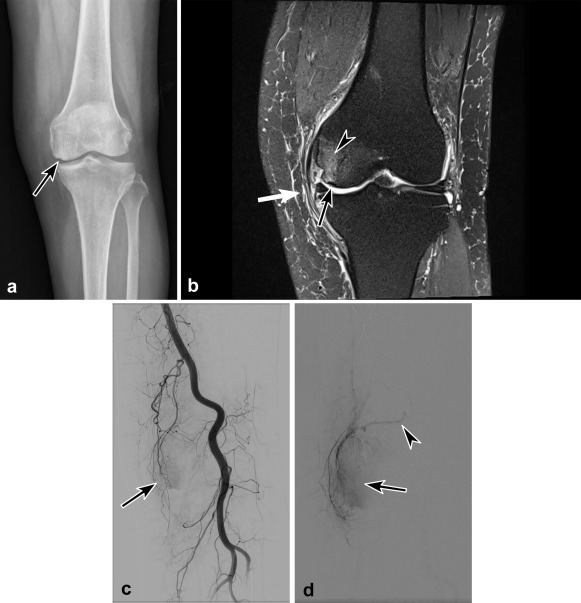 JVIR (@jvirmedia) on Twitter photo The Value of Preprocedural MR Imaging in Genicular Artery Embolization for Patients with Osteoarthritic Knee Pain | ow.ly/JgV450CyUf1 #irad The Value of Preprocedural MR Imaging in Genicular Artery Embolization for Patients with Osteoarthritic Knee Pain | ow.ly/JgV450CyUf1 #irad