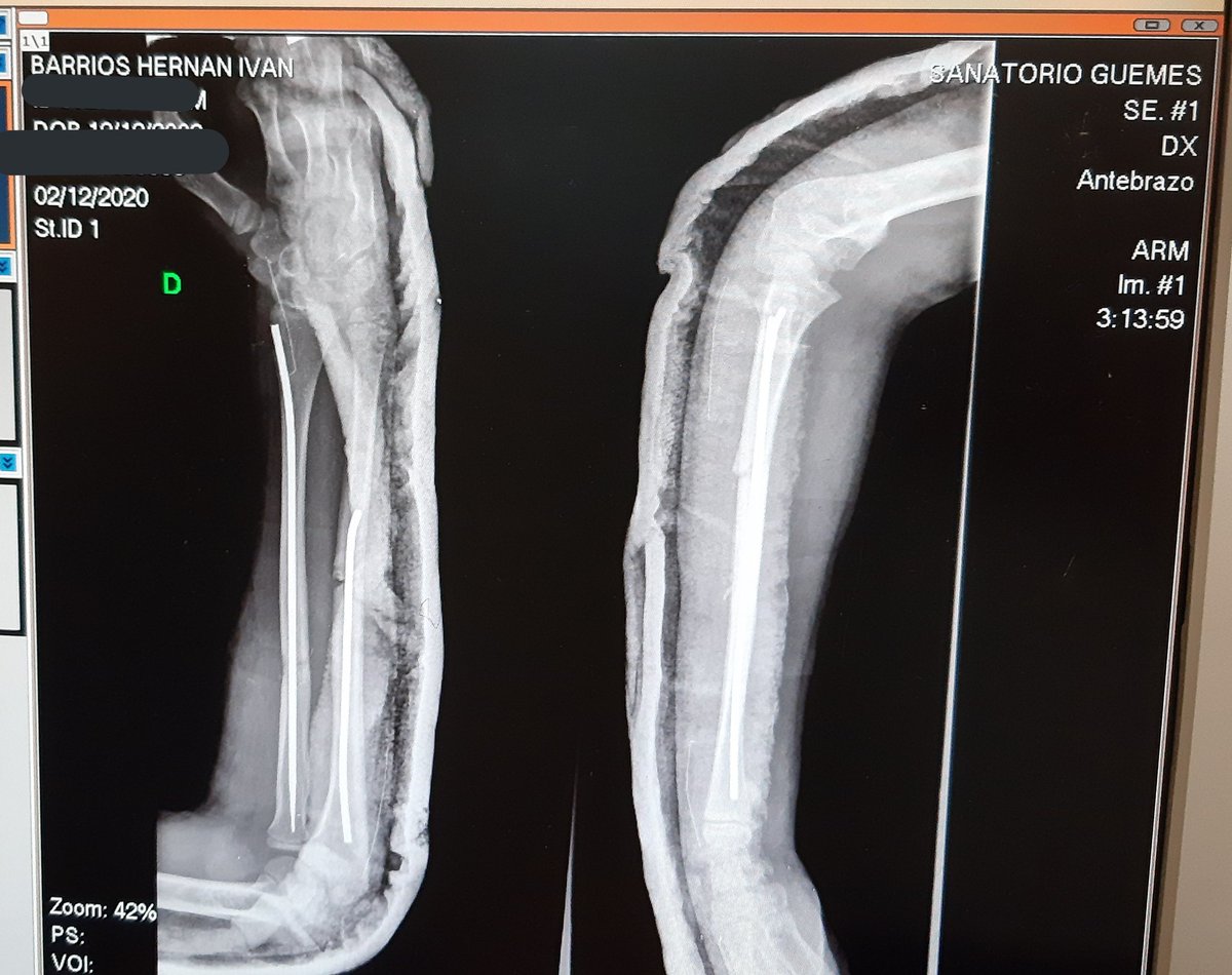 nadyadominguez's tweet photo. Éste es el brazo de Hernán hoy, sólo resta tiempo para recuperarse. Quiero agradecer inmediatamente al médico que lo operó, una inminencia combinada con calidez humana, al equipo que lo asistió en el quirófano que nos trataron de maravilla, y a todos ustedes que se preocuparon💙 https://t.co/j1tDs9ghN3
