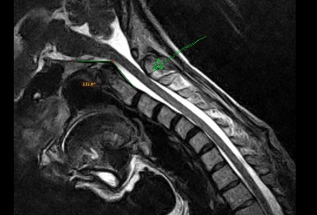 Cranio-cervical instability means *inappropriate positioning AND/OR movement of the cervical vertebrae* (including fracture), thus compromising spinal cord, and potentially also the nerves that come out of itThis and other basicranial conditions can affect diaphragm function
