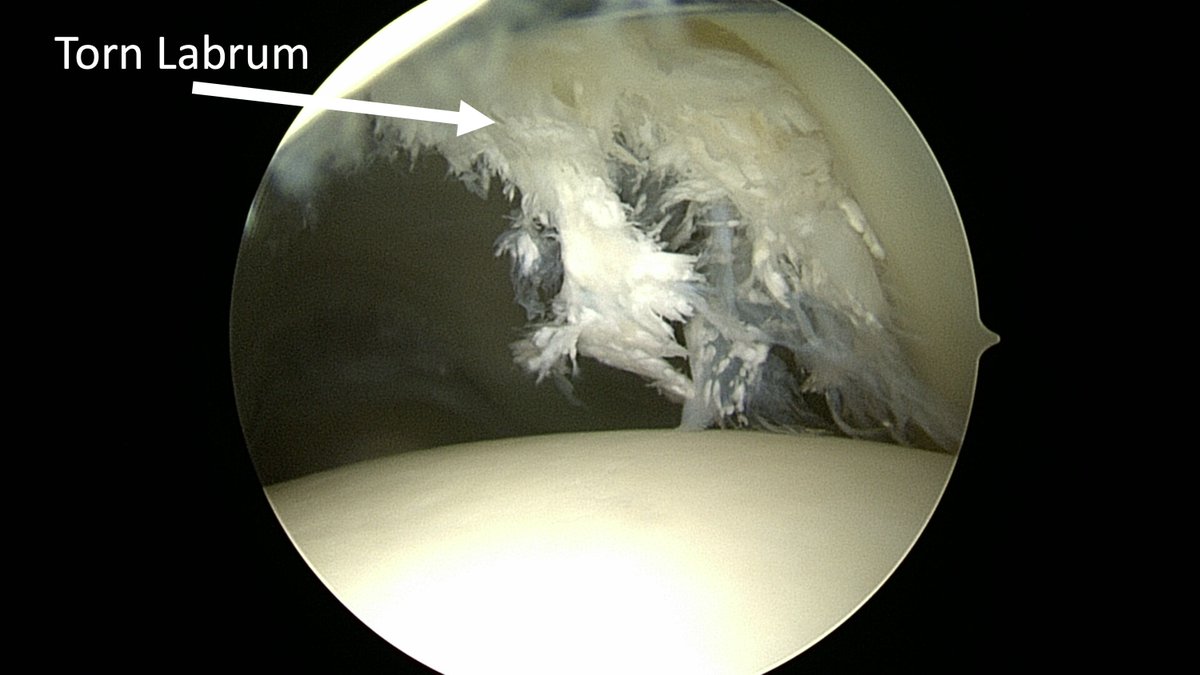 carversportsmed's tweet photo. Tears of the labrum are common causes of hip pain in active young adults. Here is a picture of a torn labrum that I recently repaired. 

Do you have hip pain? Come see me and experience the #wataugaway to see if there are treatment options available! https://t.co/KyV9iAQxxK