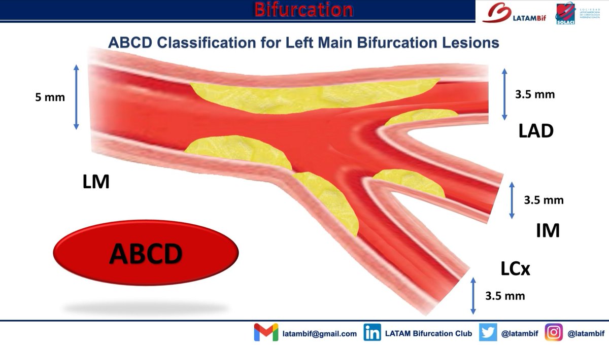 cardioelihu's tweet image. ABC de Técnicas en bifurcacion

@latambif
@luciotpadilla
@marceabud
@felixdamasds
@mornei2011
@AlcantaraCardio
@INC_CathLab
@LCathlab
@umae34cathlab
@HemoMacGregor

#HemodinamiaMacGregor #MasterTheComplex
#LATAMBif
#Bifurcacion