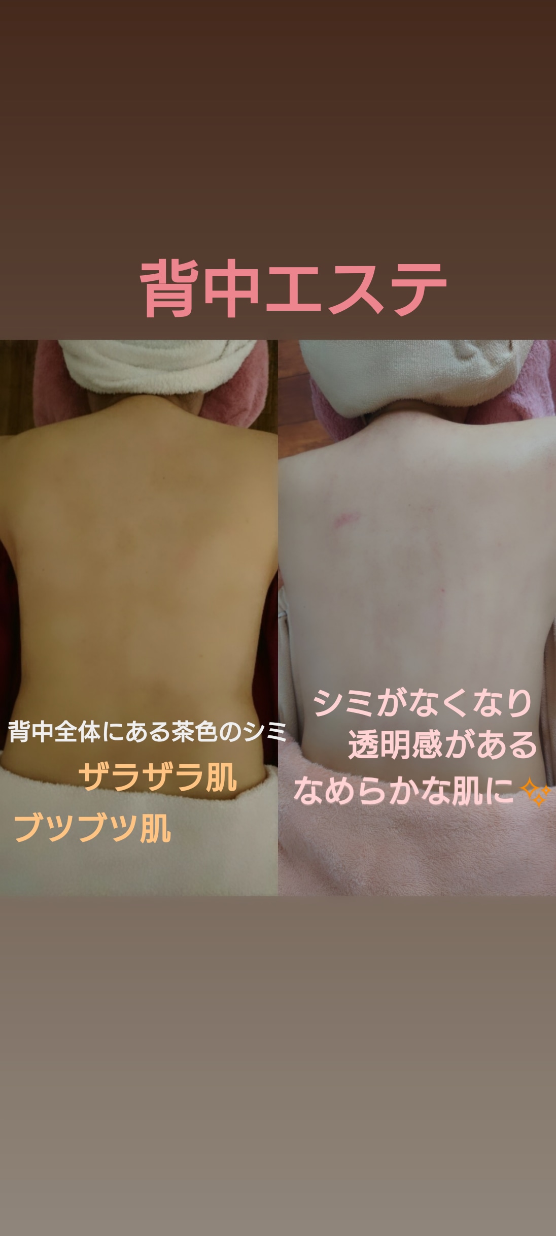 Salon M サロンエムプラス ホットペッパービューティー掲載https T Co Kyy6yenbli 背中 頭皮マッサージも入りますので施術中は皆様気持ち良く寝ていただいております 背中エステ 背中ニキビ 背中ニキビケア 背中シミケア 背中痩せ 背中美人
