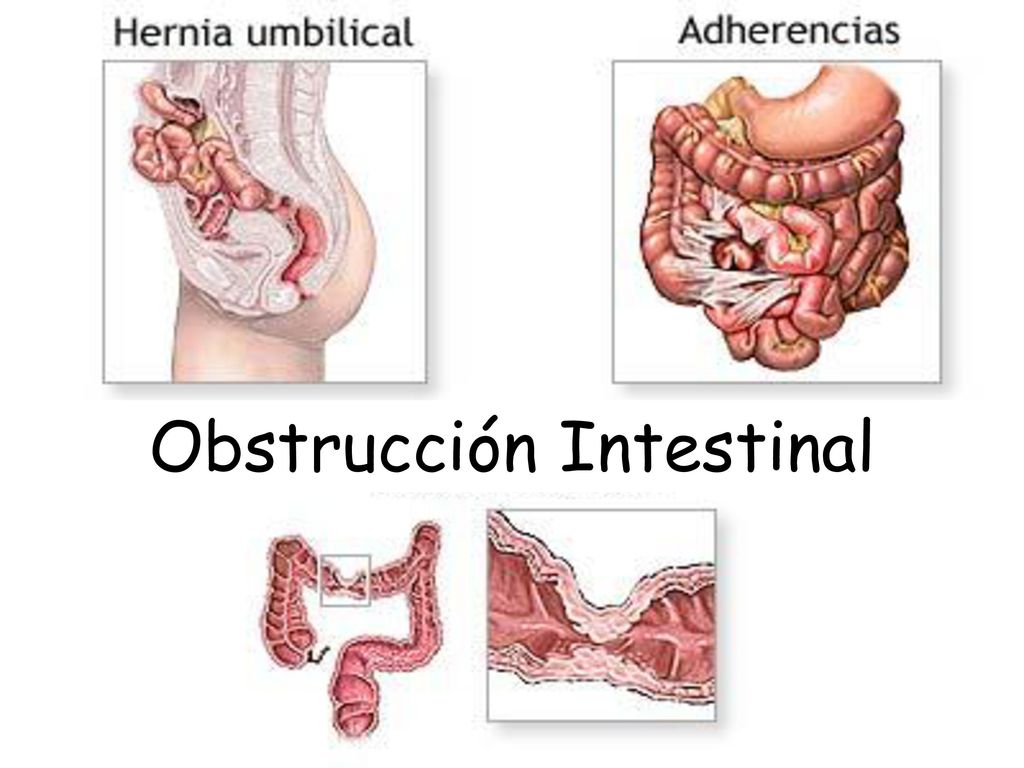 Obstrucción intestinal en ancianos tratamiento