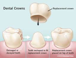 7. Crown = Topi Gigi