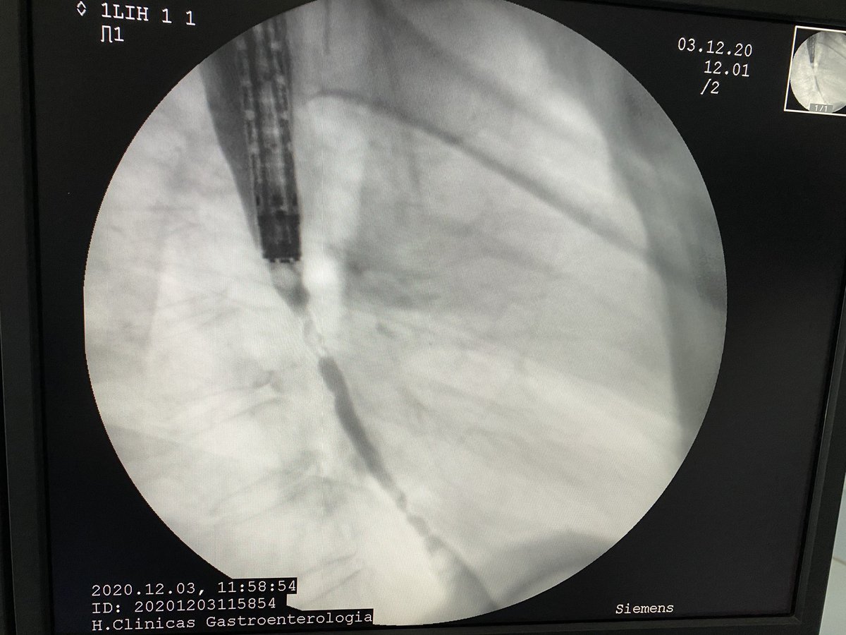 CanavesiAdrian's tweet photo. @DrJBerrueta @ENDOS96 @KMonkemuller #endoscopy #endoscopictheraphy #digestiveendoscopy https://t.co/6BtTKzHcN7