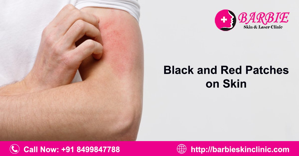 DrmnraoB's tweet image. చర్మంపై వున్న నల్ల మచ్చలు మిమ్మల్ని కలవరపెడుతున్నప్పుడు, బార్బీ స్కిన్ &amp;amp; లేజర్ క్లినిక్ లో క్స్విచ్ లేజర్ ట్రీట్‌మెంట్‌ ద్వార మీ సమస్య ను పరిష్కరించుకోండి.
Call Us: +91 8499847788
Visit Us: barbieskinclinic.com
#blackandredpatches #pathces #blackspatches #barbieskinclinic