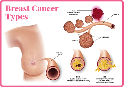 Breast Cancer ift.tt/3qNEjoo