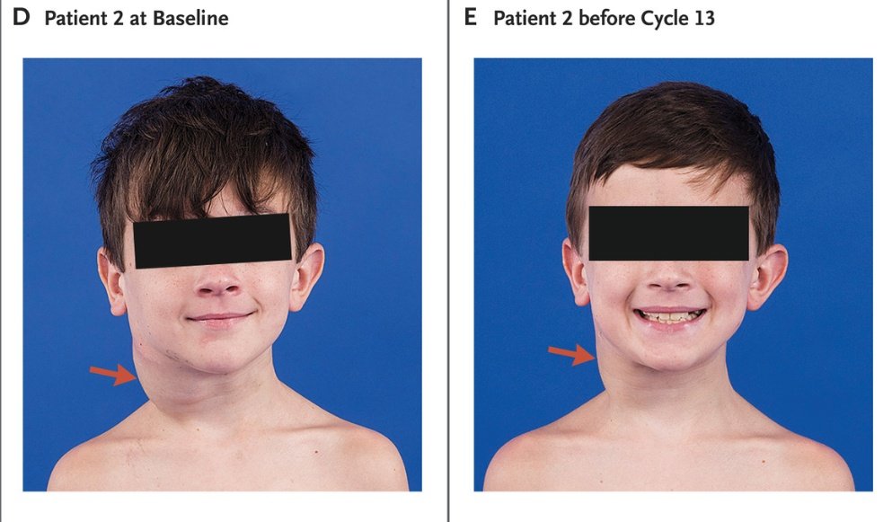 Since they did the hard work, we can search through their database to see if any of the drugs in the library might reduce TMPRSS2 expression. As it turns out, a few appeared to, including a drug from a class known as MEK inhibitors, sometimes used to treat neurofibromatosis.