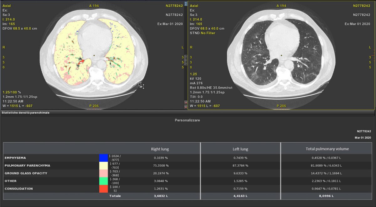 Original Article: Chest Radiology COVID-19 pneumonia: computer-aided quantification of healthy lung parenchyma, emphysema, ground glass and consolidation on chest computed tomography (CT) link.springer.com/article/10.100… #COVID #radiology @AlfonsoReginel1 @mielesirm